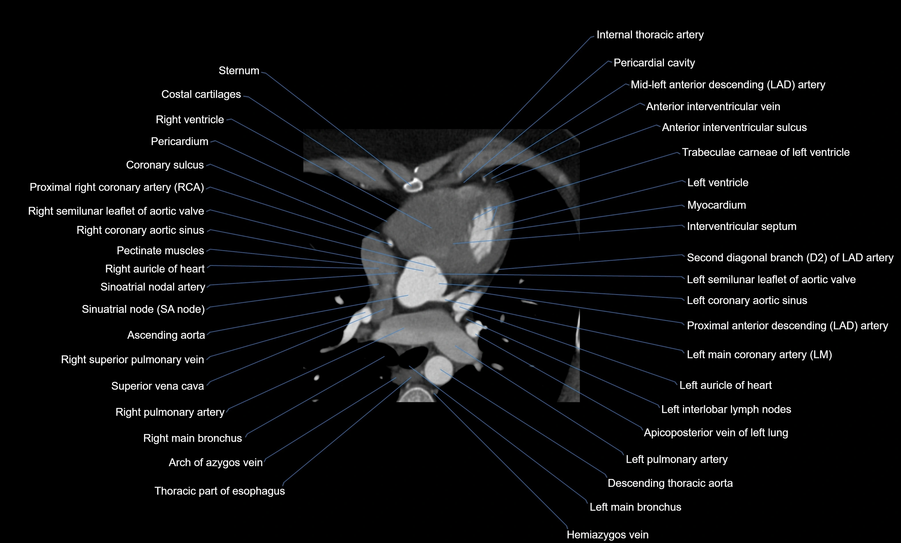 CT heart (coronary angiogram) four chamber view  cross sectional anatomy labelled radiology image -00020.webp
